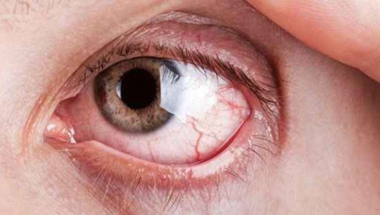 Göz kanlanması nedir? Göz kanlanmasına ne iyi gelir?
